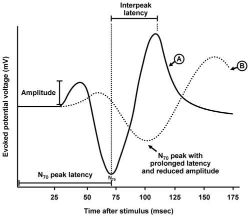 Evoked Potential Waveform